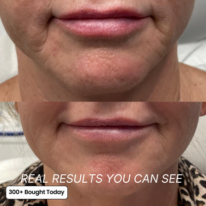 Smooth Wrinkles, Fine Lines & Tired Creases Without Needles