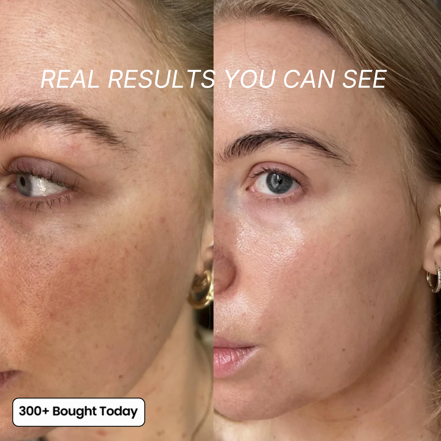 Smooth Wrinkles, Fine Lines & Tired Creases Without Needles